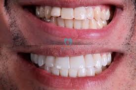 Clareamento dental