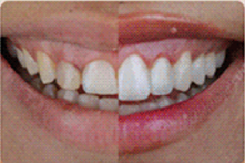 Microagulhamento com Peeling